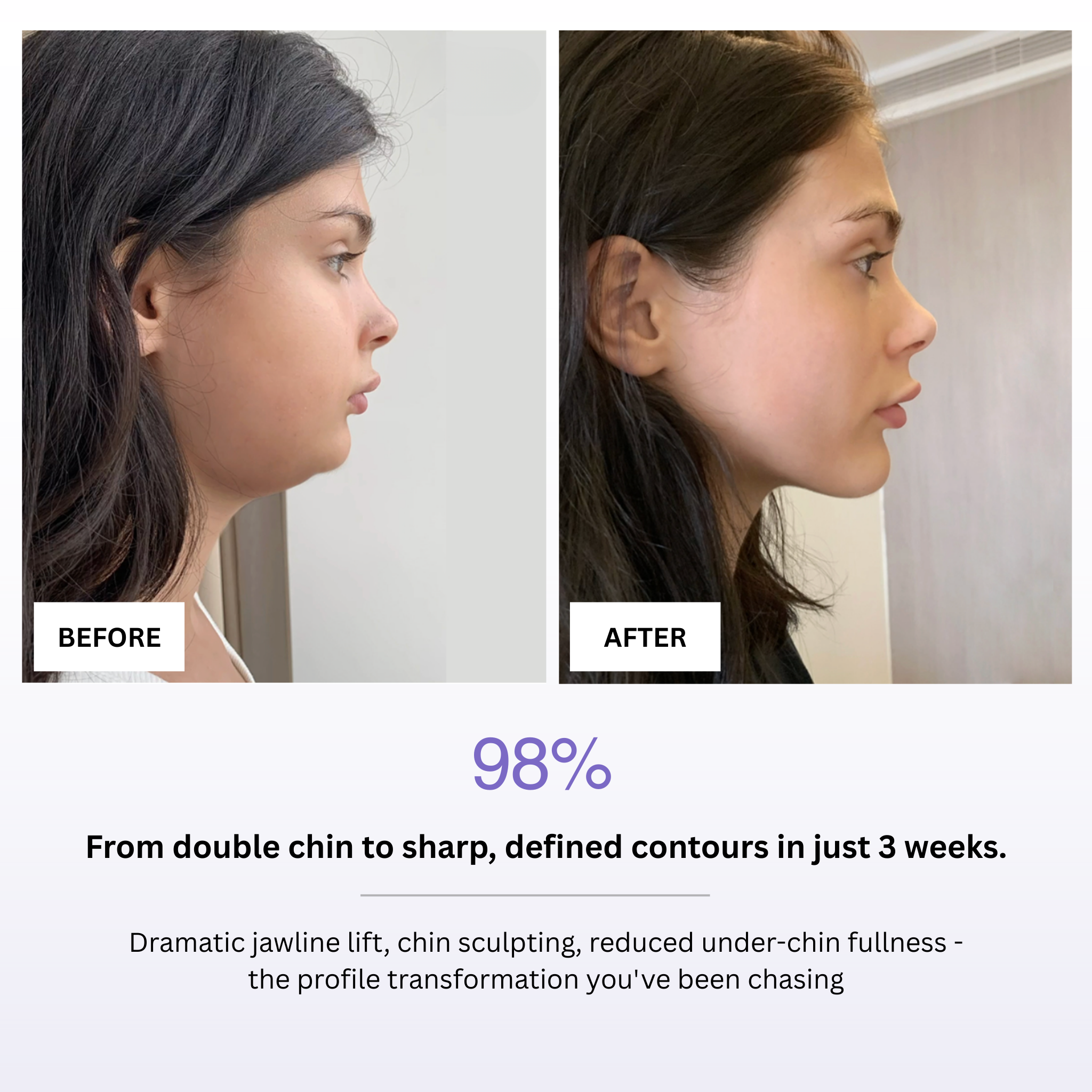 Before and after comparison of a woman's profile with text highlighting jawline lift and chin sculpting results.