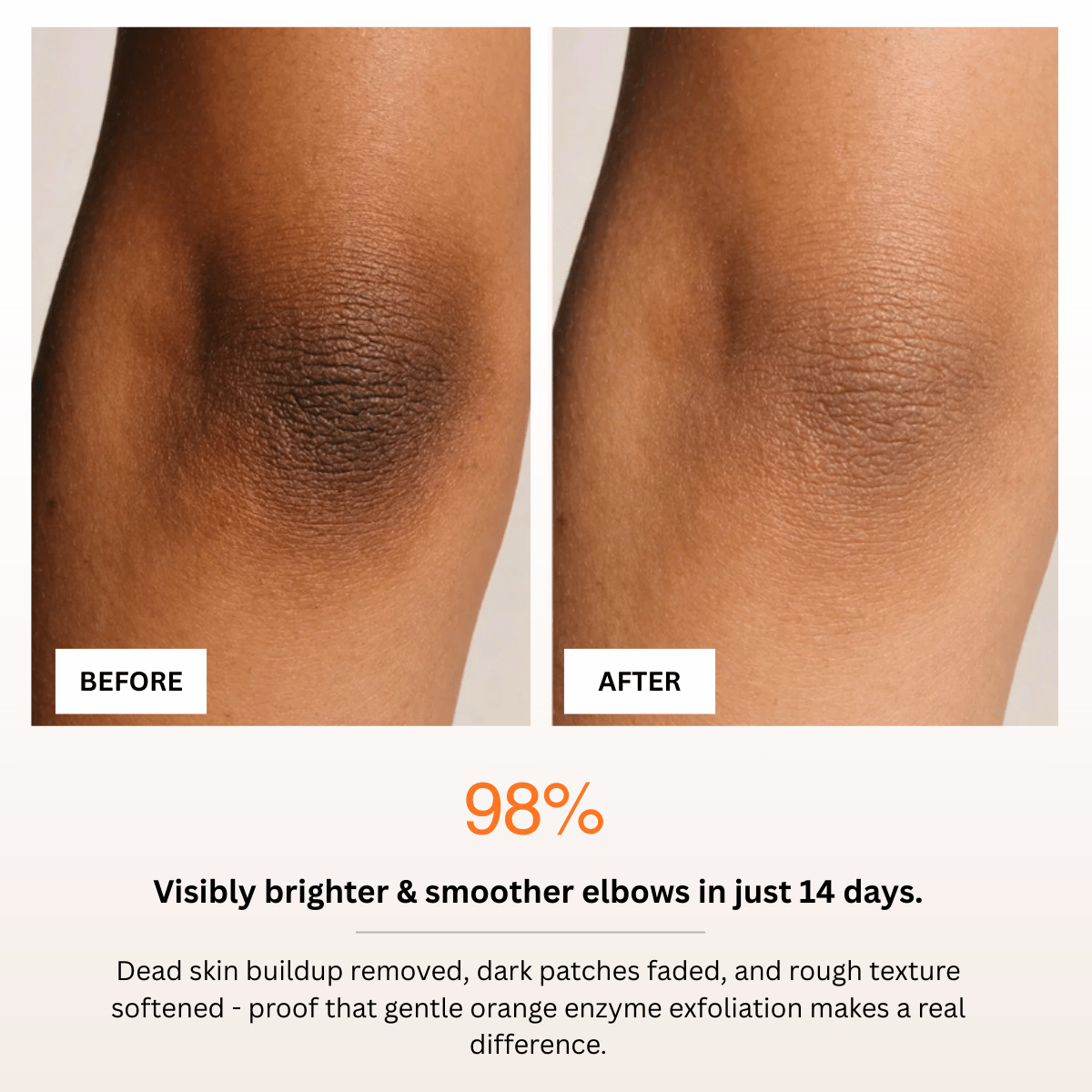 Before and after comparison of elbows with text indicating 98% improvement in skin brightness and smoothness.