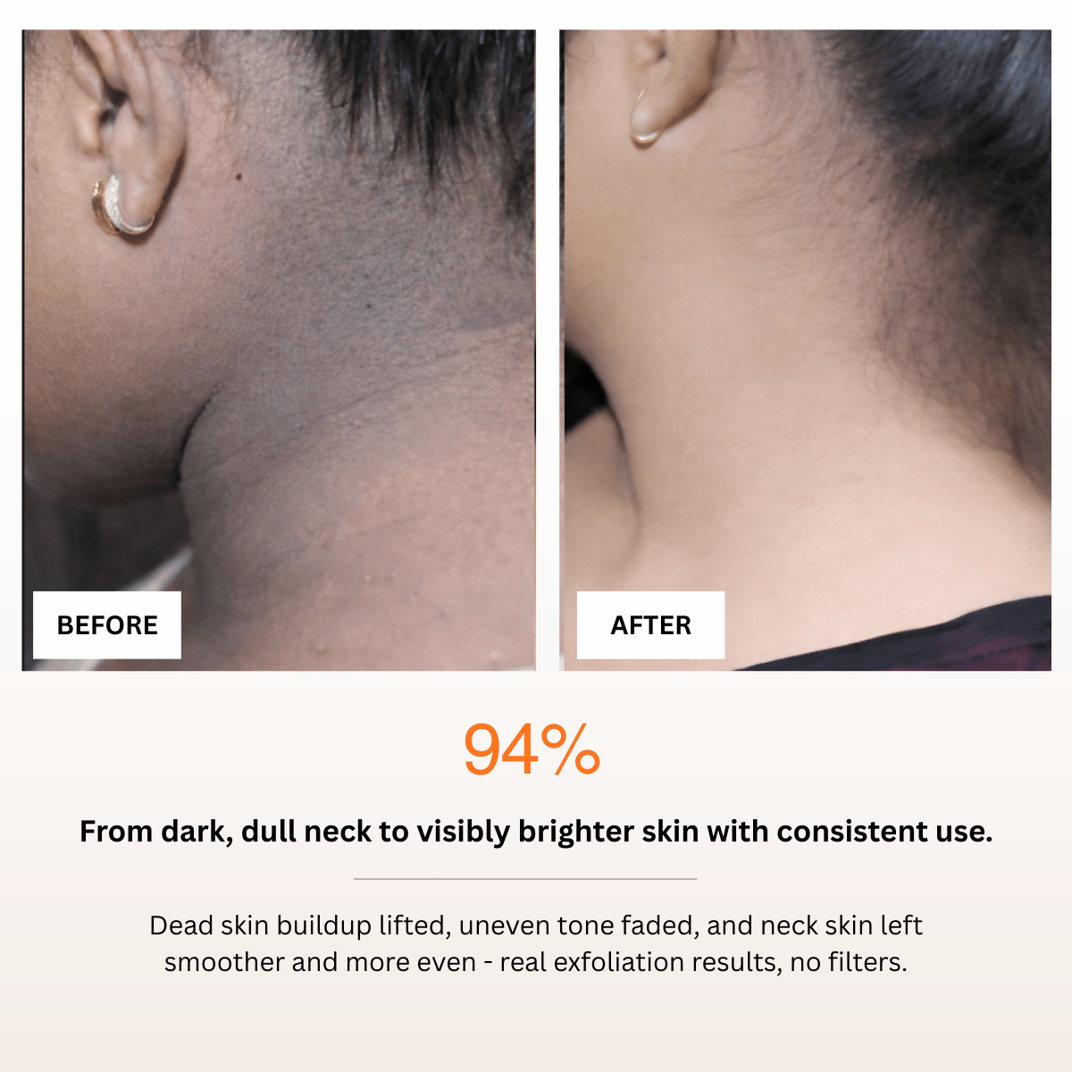 Before and after comparison of neck skin with text indicating improvement.