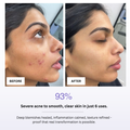 Before and after comparison of a person's face with severe acne, showing smooth skin after 6 uses of a product.