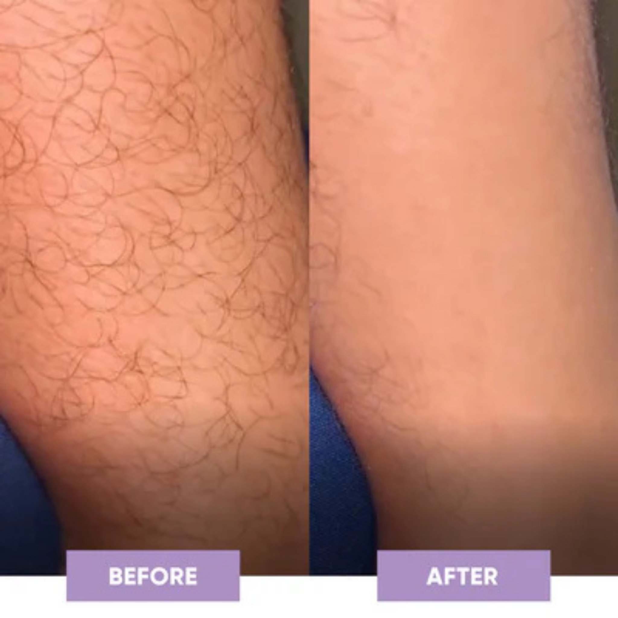 Before and after comparison of a person's leg hair with 'Before' on the left and 'After' on the right.