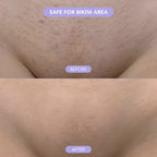 Before and after comparison of a bikini area with text indicating safety for the area.