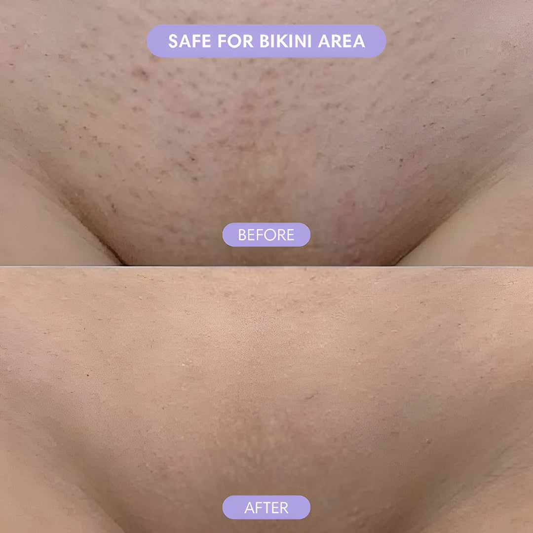 Before and after comparison of a bikini area with text indicating safety for the area.