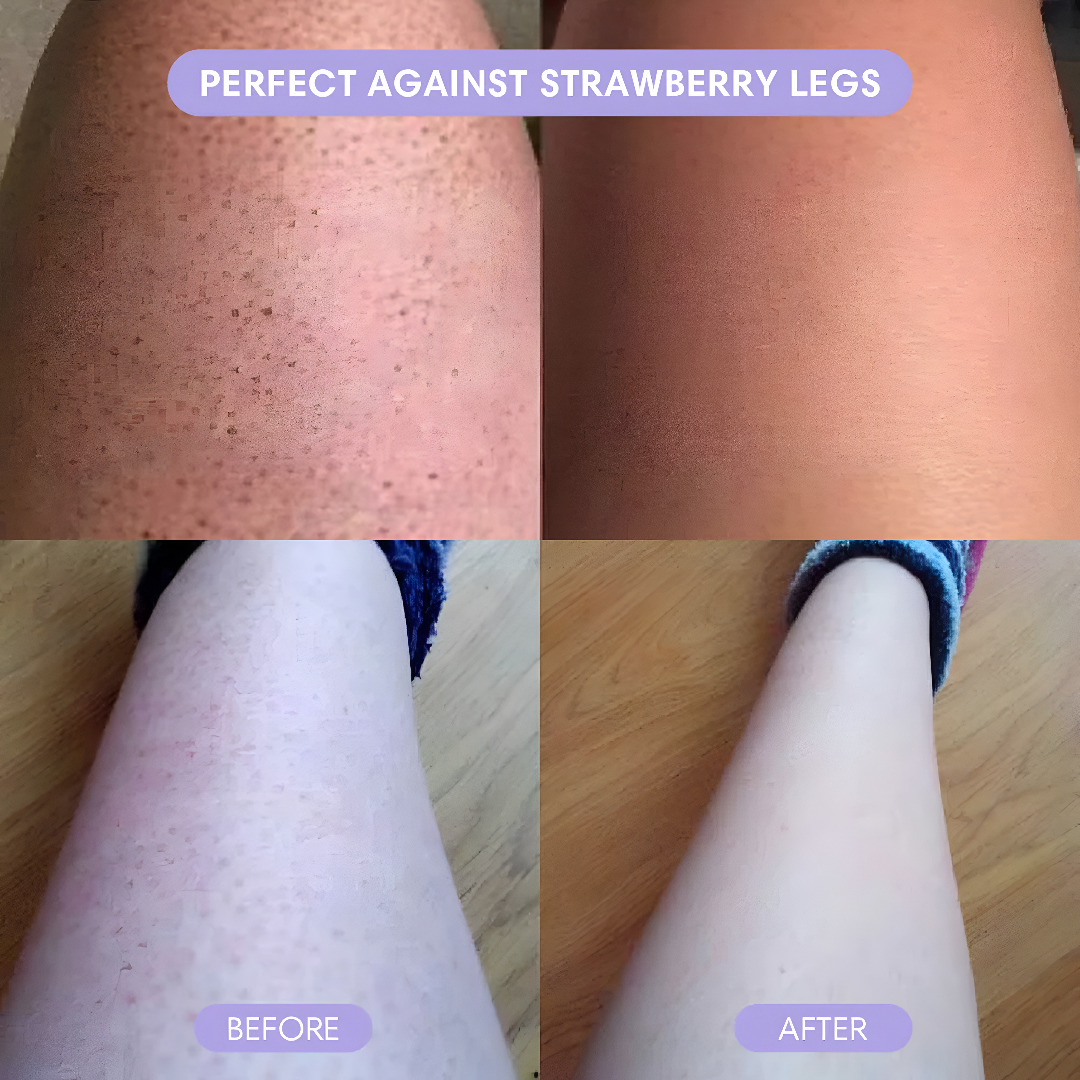 Before and after comparison of legs with text 'Perfect Against Strawberry Legs' and 'Before'/'After' labels.