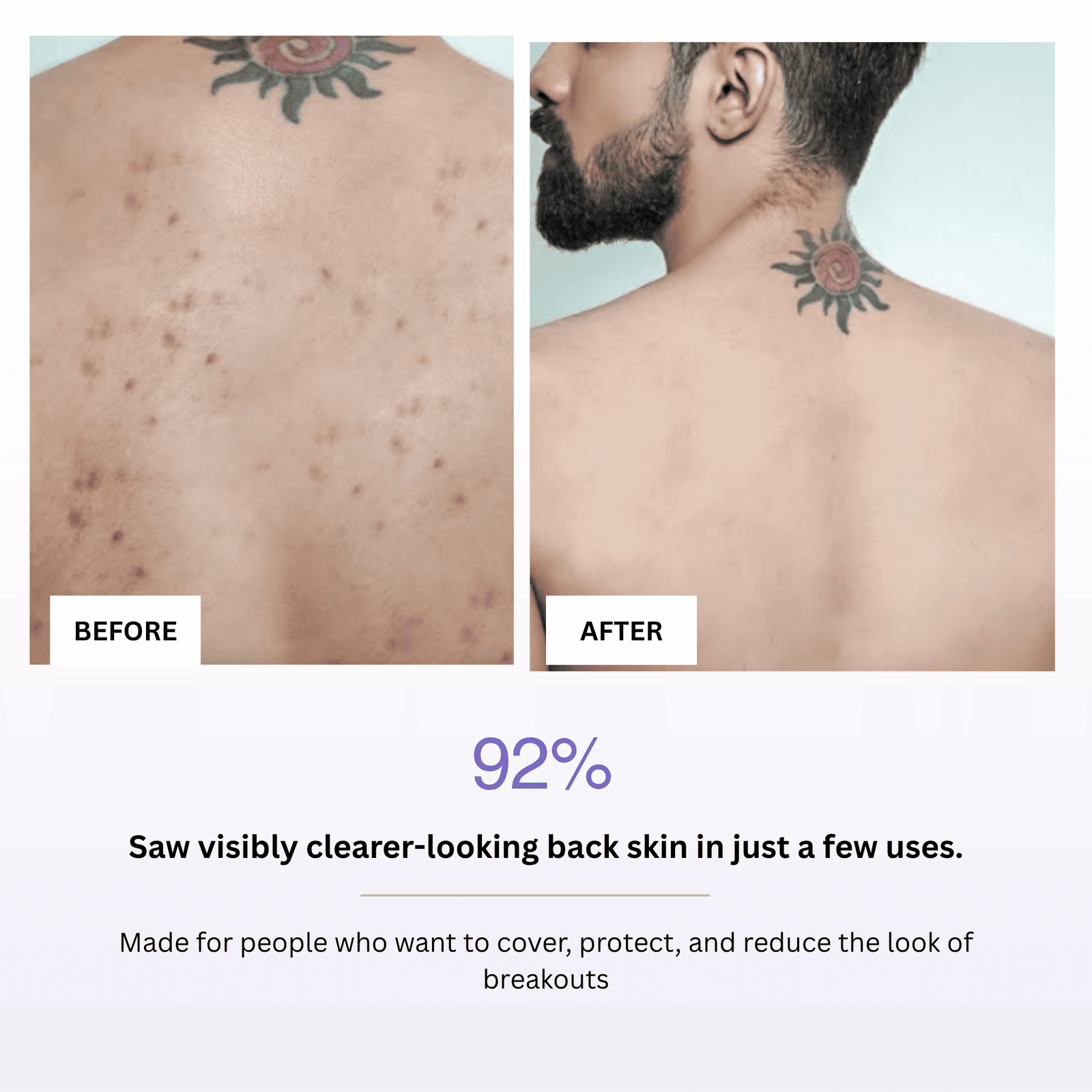Before and after comparison of a person's back with visible acne, showing clearer skin.