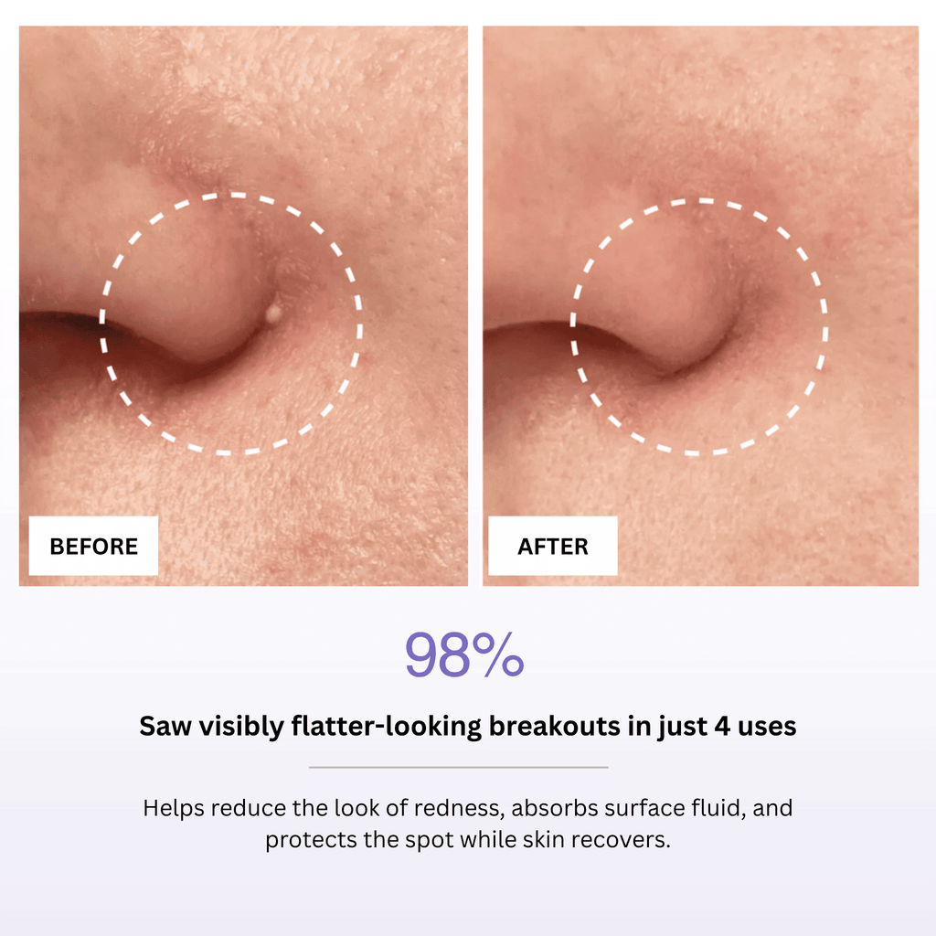 Before and after comparison of skin with a spot, showing 98% reduction in breakouts.