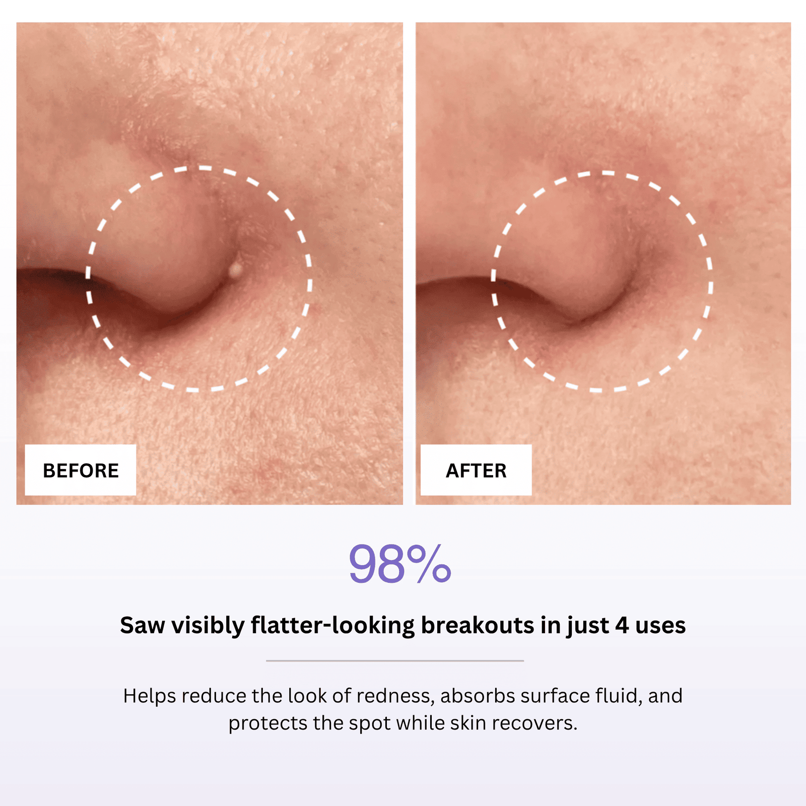 Before and after comparison of skin with a spot, showing 98% reduction in breakouts.