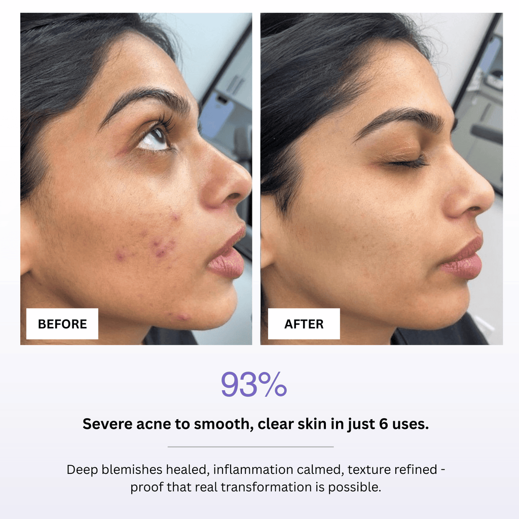 Before and after comparison of a person's face with severe acne, showing healed skin after 6 uses of a product.