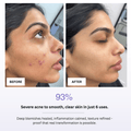 Before and after comparison of a person's face with severe acne, showing healed skin after 6 uses of a product.