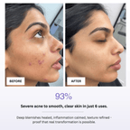 Before and after comparison of a person's face with severe acne, showing healed skin after 6 uses of a product.