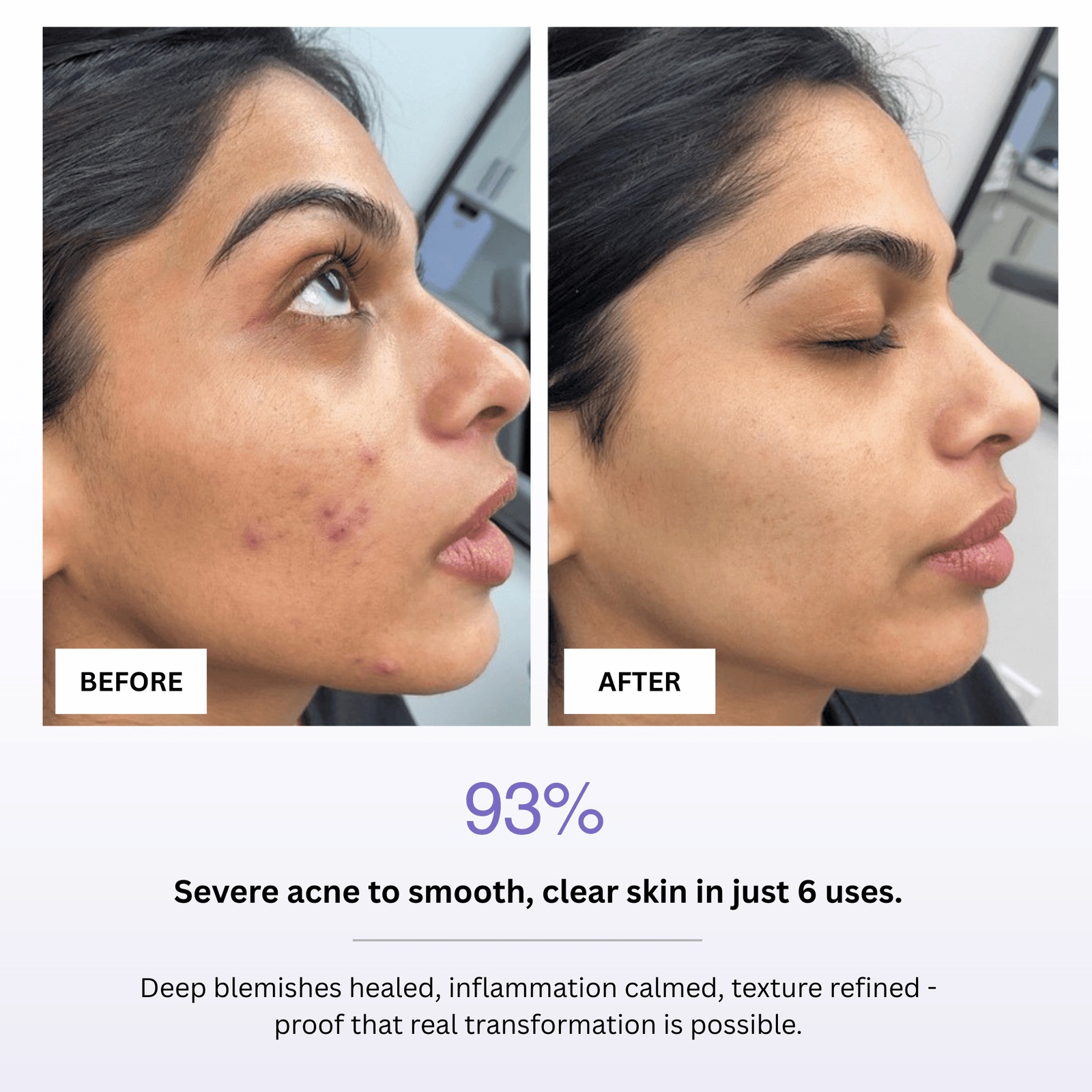 Before and after comparison of a person's face with severe acne, showing healed skin after 6 uses of a product.