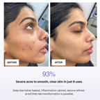 Before and after comparison of a person's face with severe acne, showing smooth skin after 6 uses of a product.